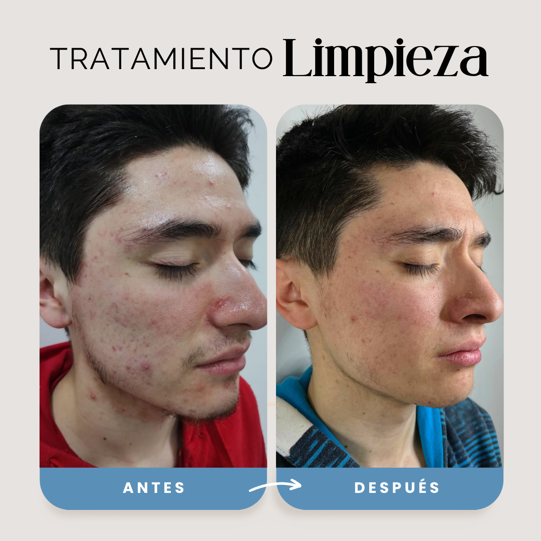 Limpieza Facial
