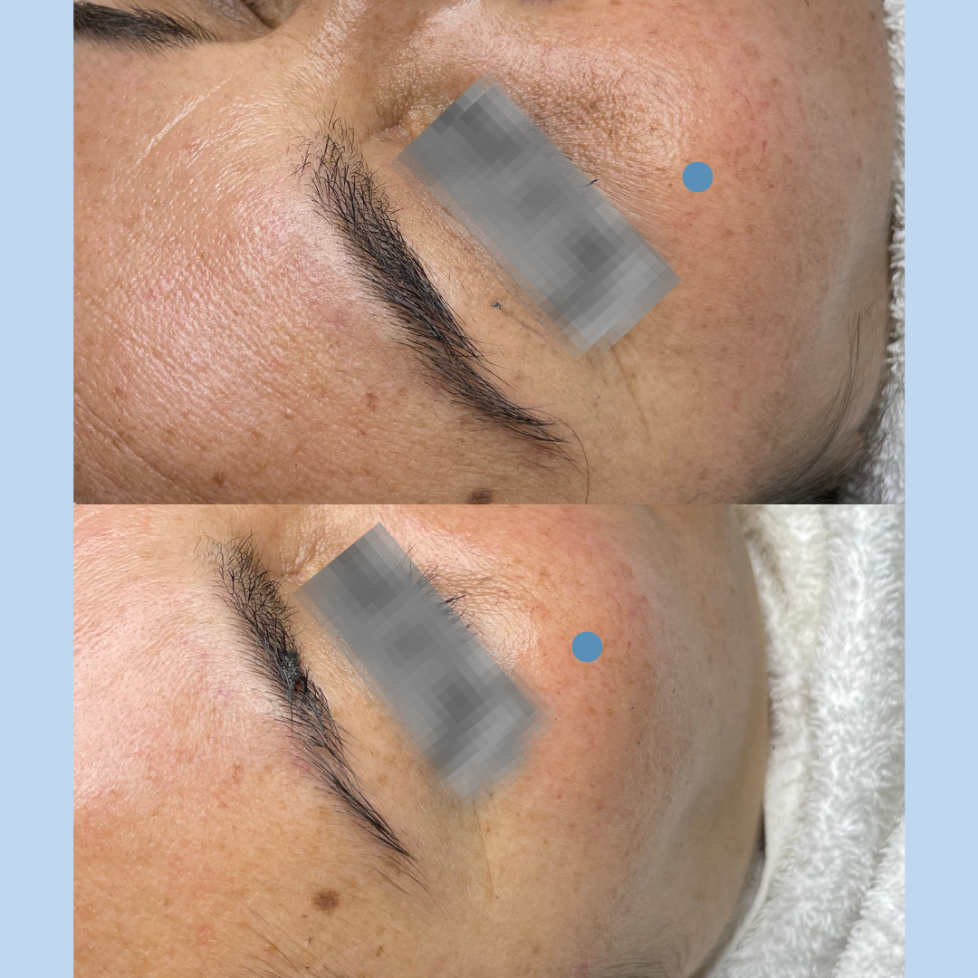 Plasma Rico en Plaquetas | PRP 3 sesiones