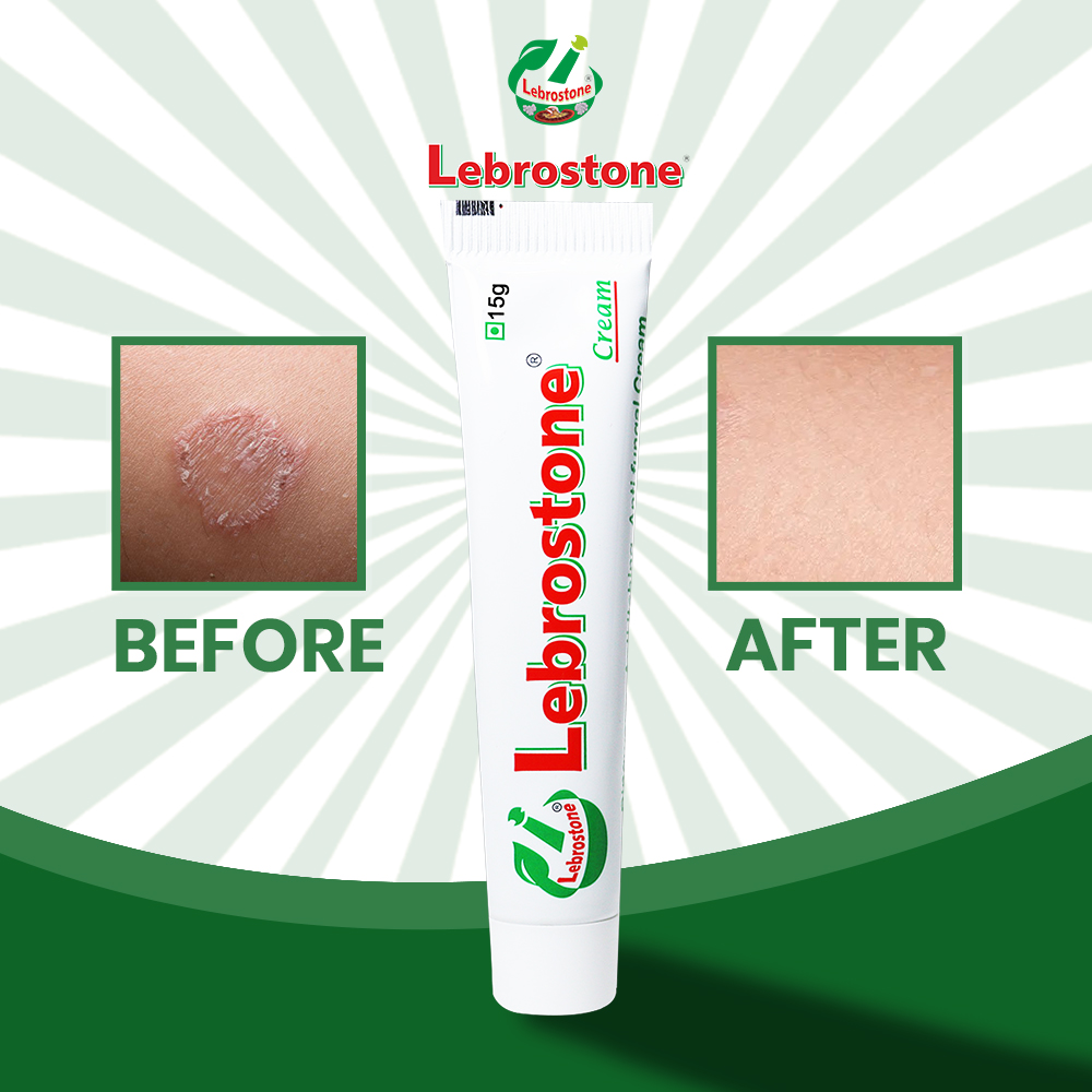 Lebrostone Ayurvedic Antifungal Cream | Herbal Ringworm, Itching & Fungal Infection Treatment | Tea Tree Oil & Turmeric | Fast Relief Skin Care - 15g