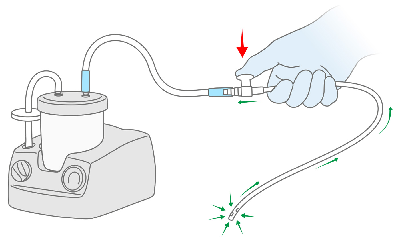Suction catheters. Finger Control Connector
