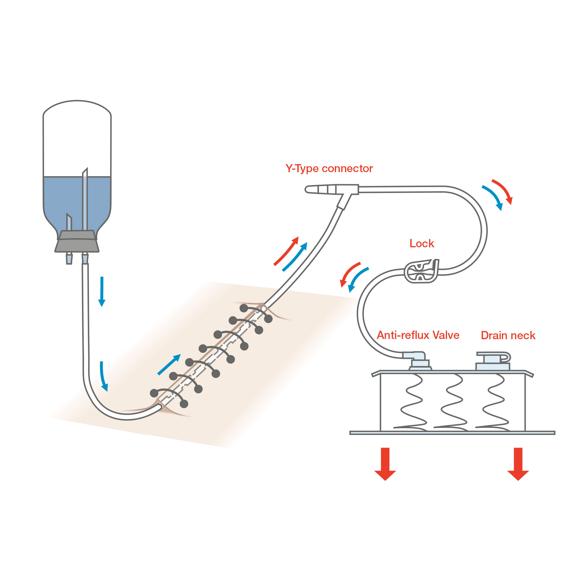 Wound Drainage Set with Spring Reservoir