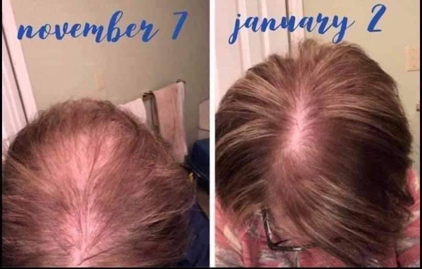 Hair Thinning Serum