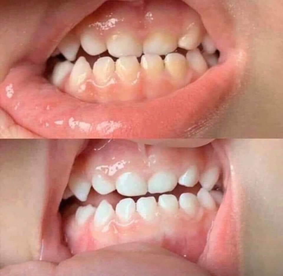 Whitening Toothpaste