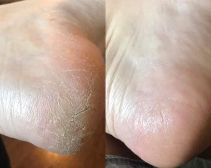 Sole Solution Foot Treatment