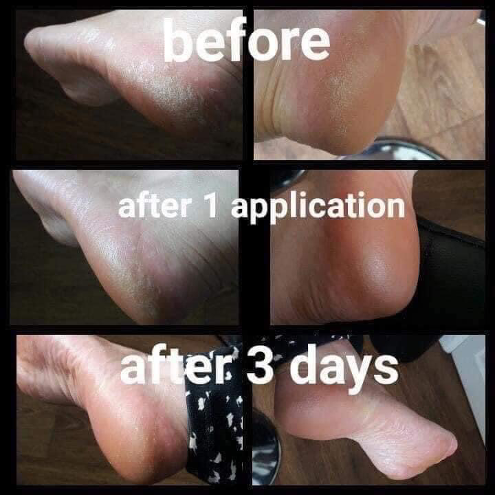 Sole Solution Foot Treatment