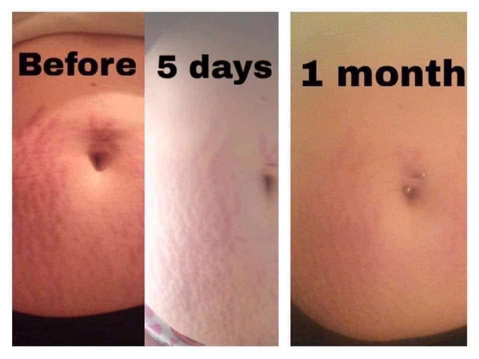Stretch Mark Cream
