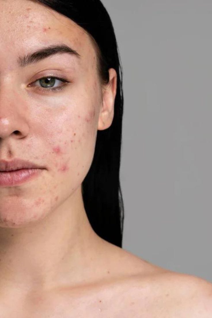 LIMPIEZA ANTI ACNE