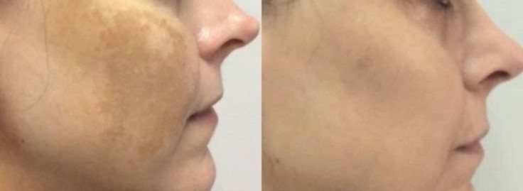 Pomada Clareadora Pós Peeling 20g