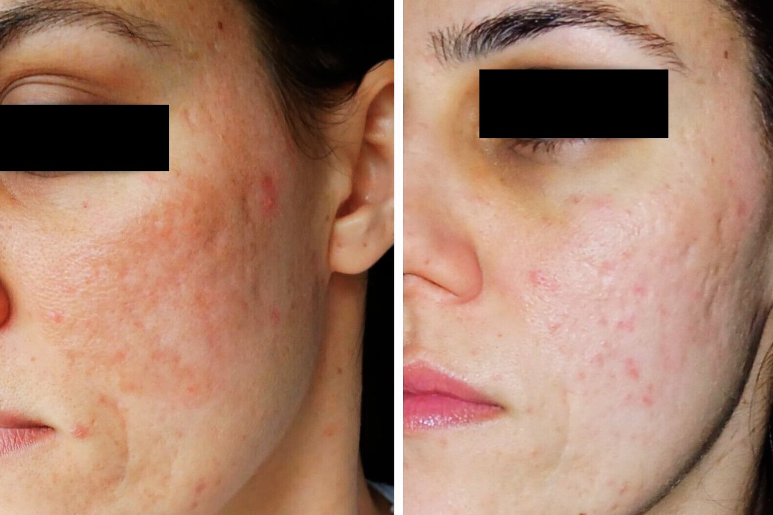 Pomada Clareadora Pós Peeling 20g