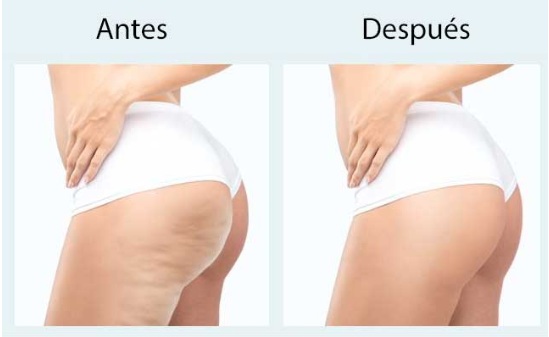 Carboxiterapia Corporal