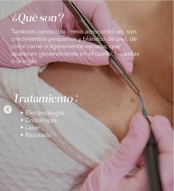 Eliminación de Fibromas