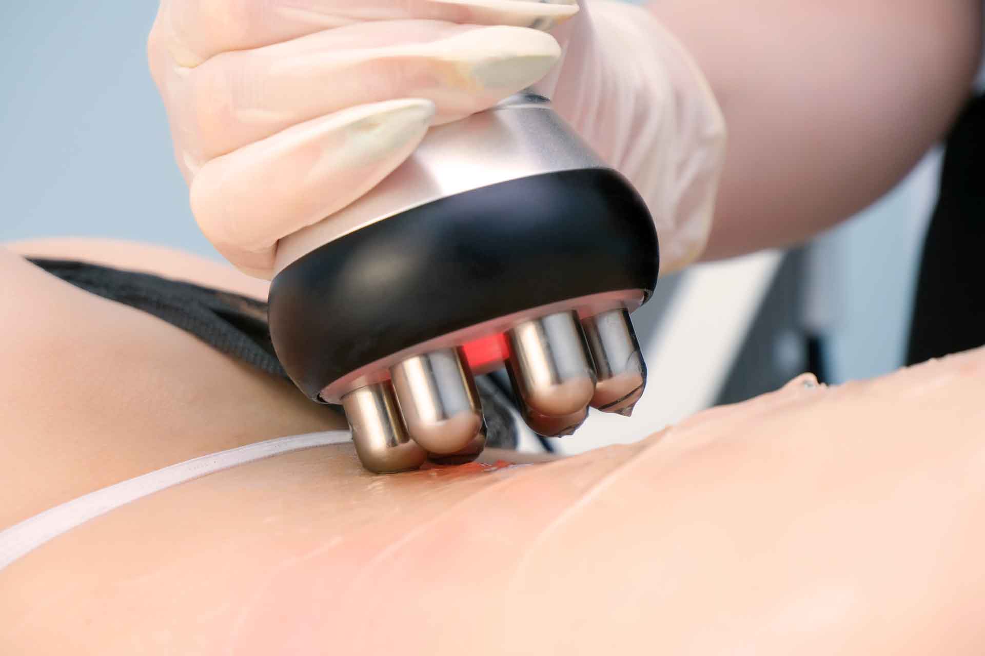 Radiofrecuencia Corporal