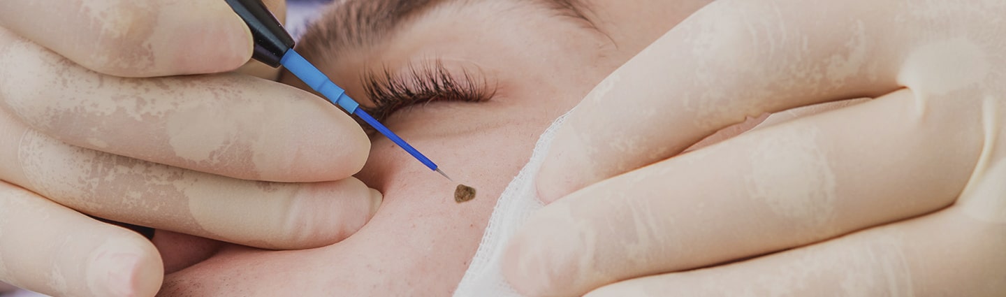 Retiro de verrugas y lunares con Anestesia