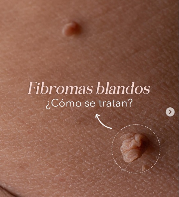 Eliminación de Fibromas