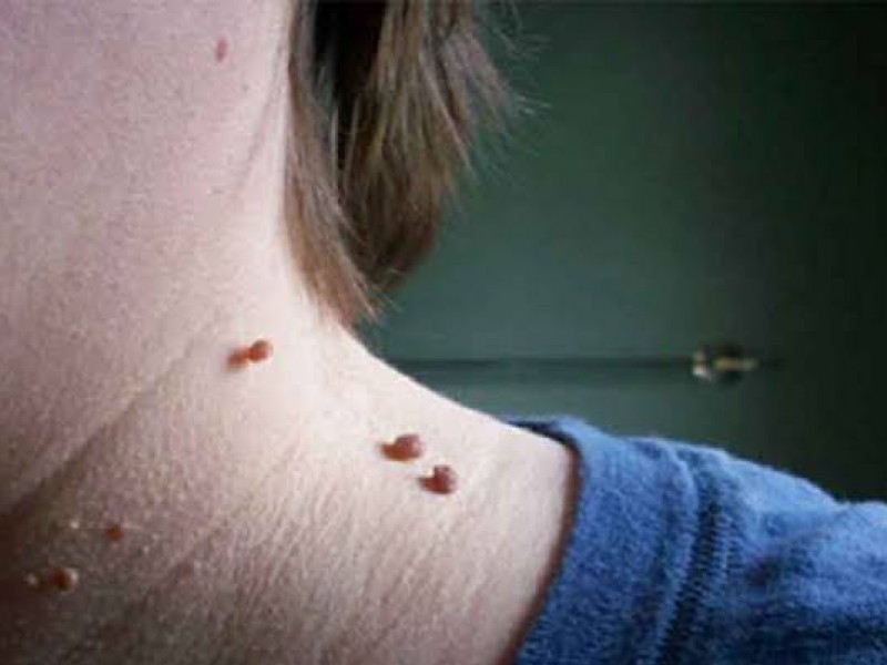 Eliminación de puntos rojos, mezquinos y queloides por piercing