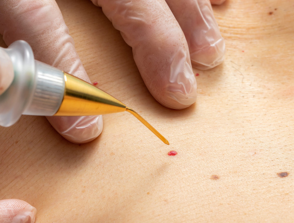 Eliminación de puntos rojos, mezquinos y queloides por piercing