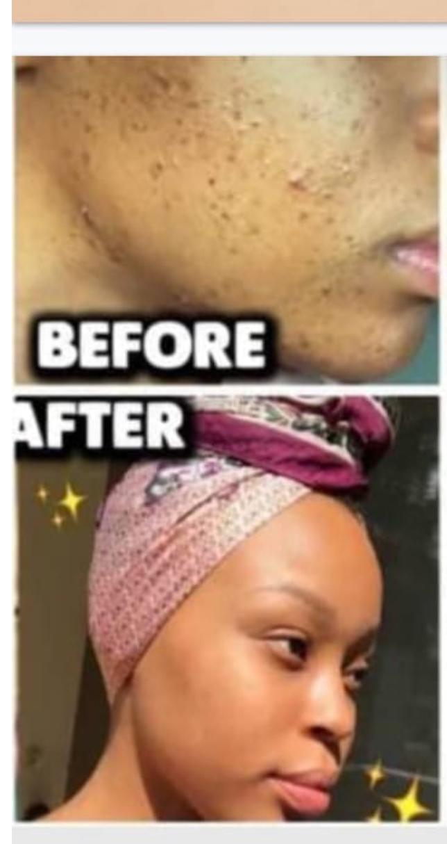 Acne Scar Removal Cream