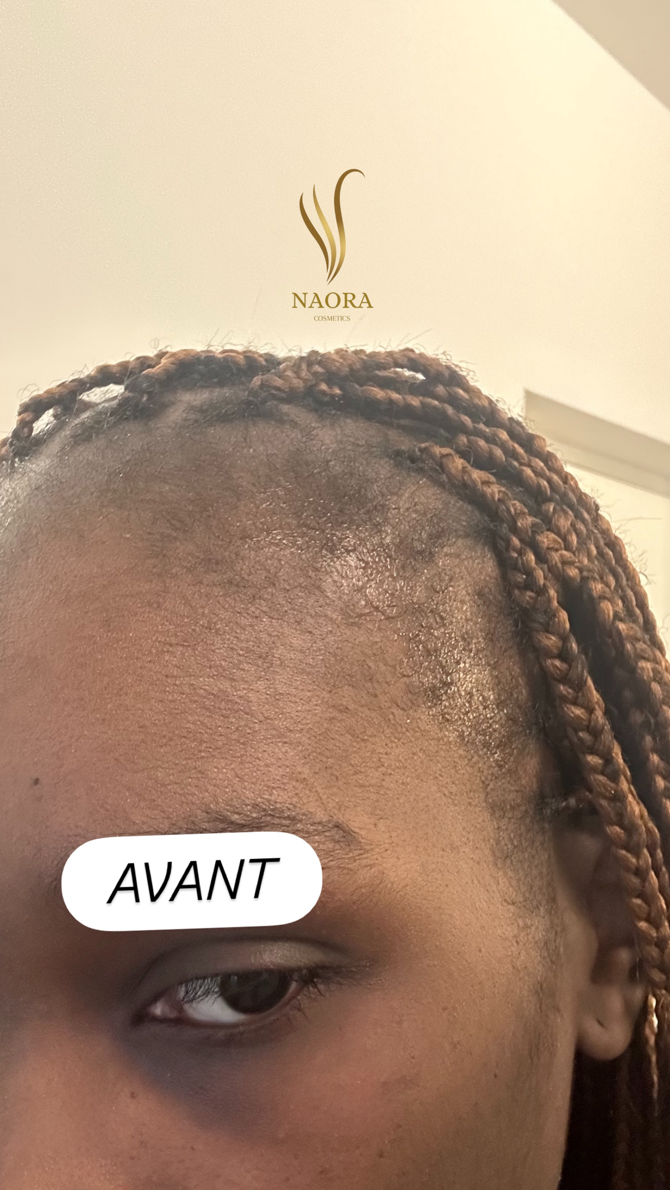 Densifie tes tempes & comble les trous de barbe en quelques semaines 🔥