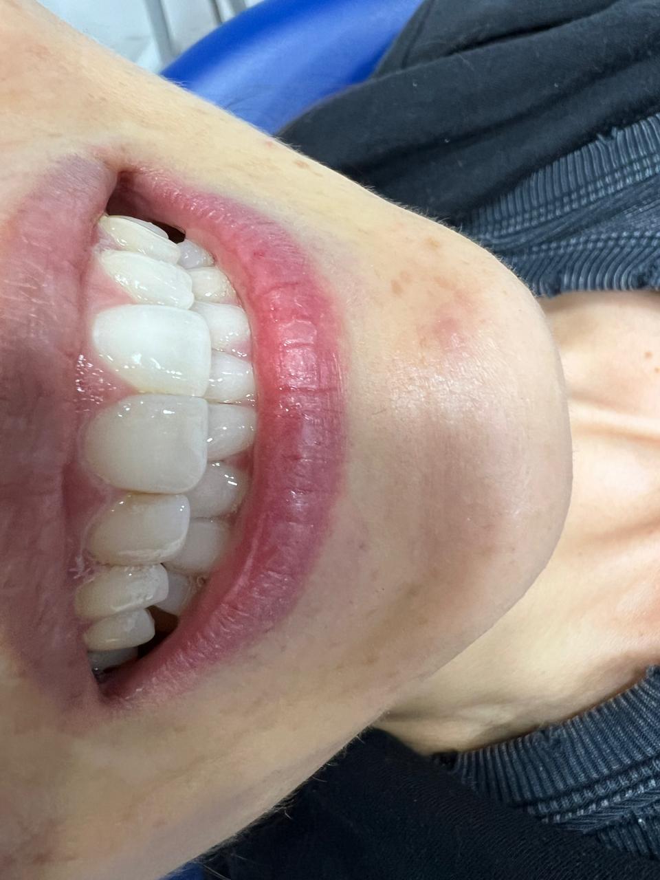 Blanqueamiento Dental