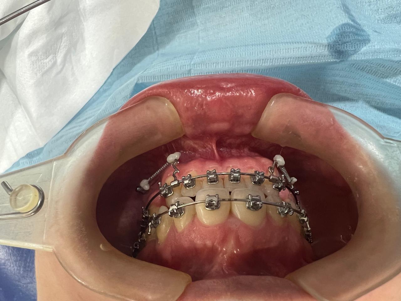 Ortodoncia de Autoligado