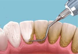 Periodoncia Básica (Raspado y Alisado Radicular)