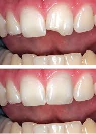 Reconstrucción Dental