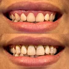 Contorneado Gingival (Gingivectomía Estética)