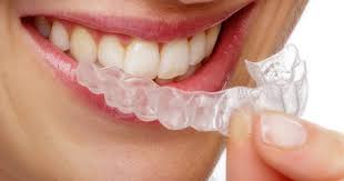 Bruxismo y Guardas Oclusales