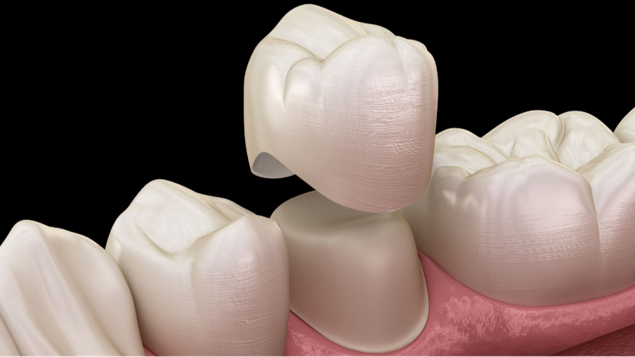 Coronas y Puentes (Zirconia/Cerámica)