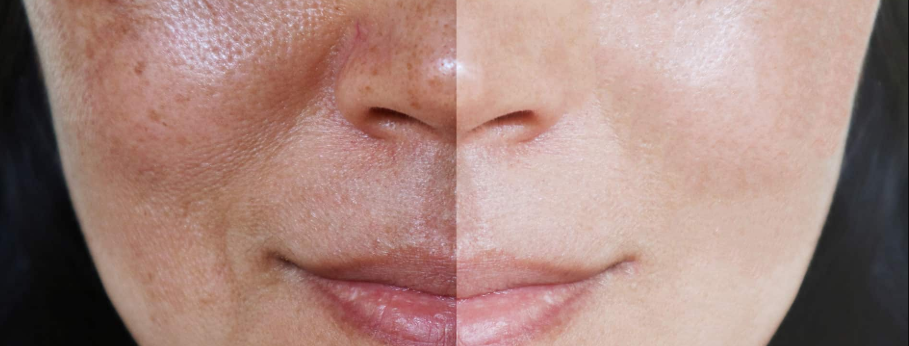 PEELING FACIAL
