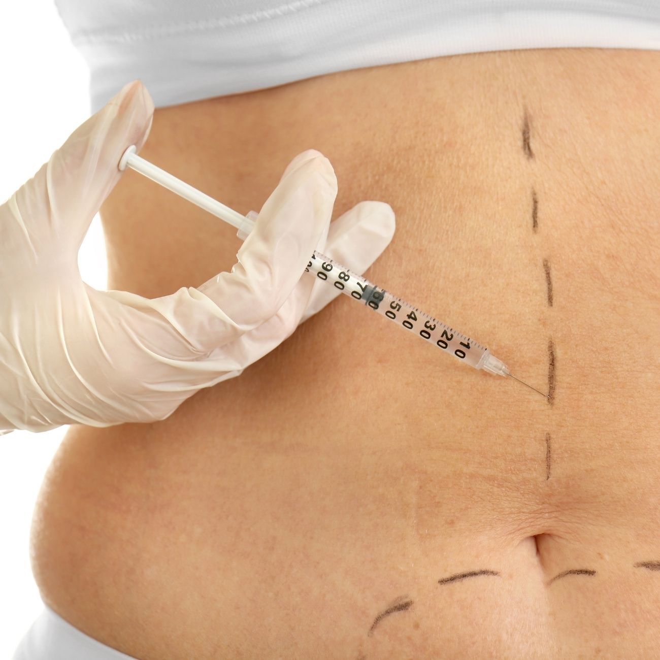 MESOTERAPIA 5 sesiones