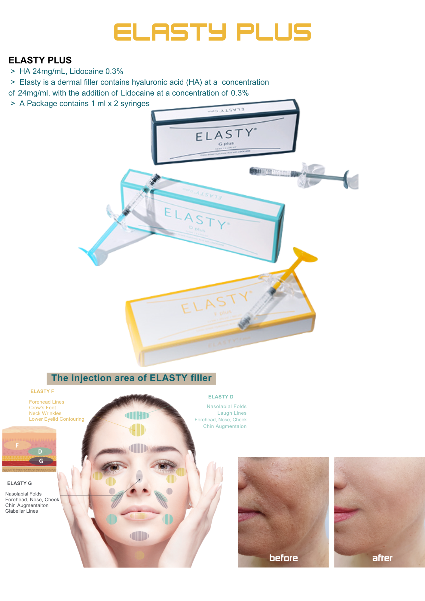 ELASTY PLUS Dermal Filler