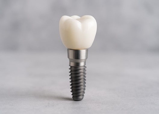 Dental Implant