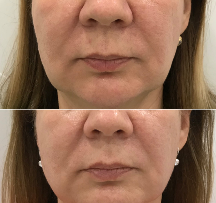 LIPO ENZYME APPOINTMENT (DEPOSIT)