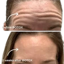 BOTOX APPOINTMENT (DEPOSIT)