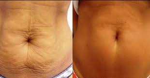 Stretch Remarks & Stomach Tightening