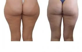 Thighs
