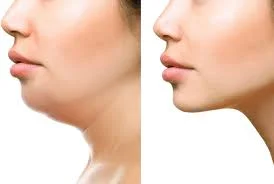 LIPO ENZYME - Double Chin