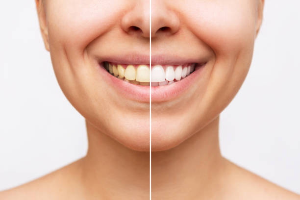 TEETH WHITENING - TOUCH-UP SESSION (within 4-6 weeks)