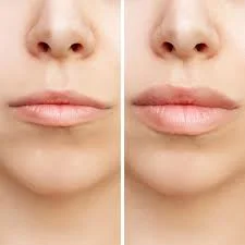 Juvederm
