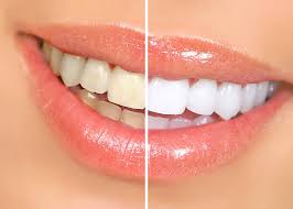 TEETH WHITENING APPOINTMENT (DEPOSIT)