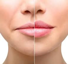 LIP INJECTIONS APPOINTMENT (DEPOSIT)