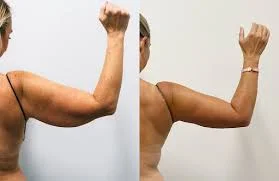 Arms