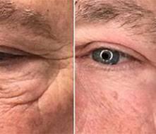 FIBROBLAST PEN APPOINTMENT (DEPOSIT)