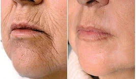 FIBROBLAST PEN - Upper Lip/Smoker Lines - Treatment (MID FACE)