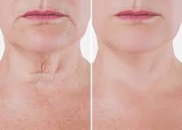 Neck Lift (LOWER FACE)