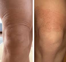 Knee Lift (BODY AREAS)