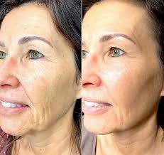 Jowls (LOWER FACE)