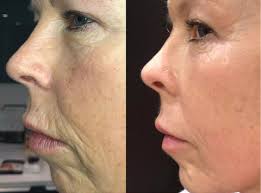 Nasolabial Folds (MID FACE)