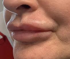 LIP FILLER - Lip Dissolving